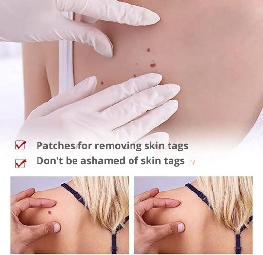 Plant-Based Wart and Skin Spot Remover Pen with Precision Applicator